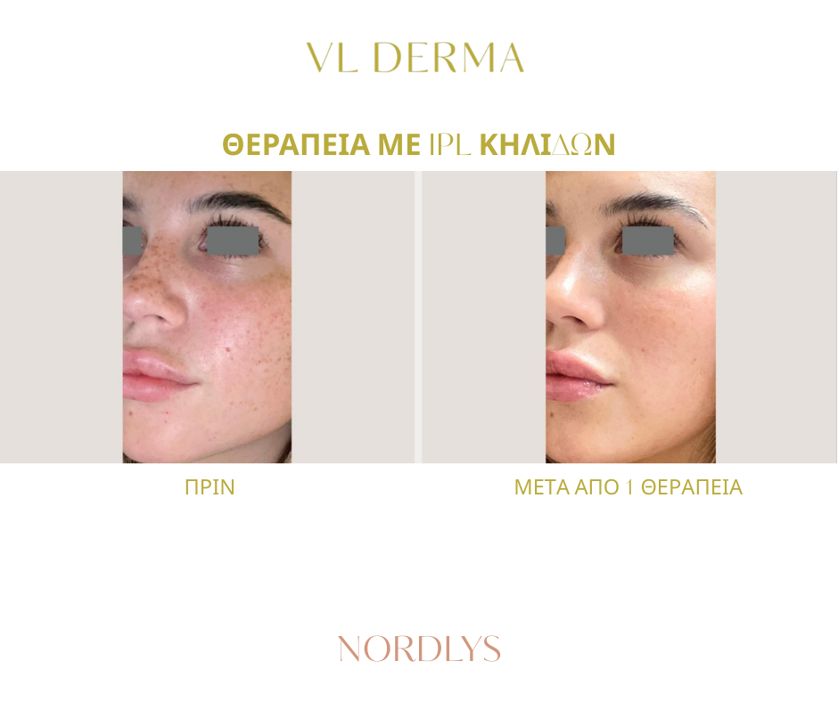 After 1 Combination Treatment (3)